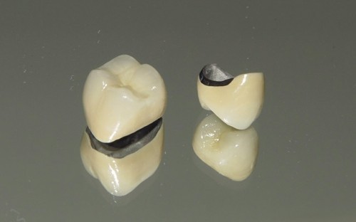 b2ap3_large_1 انواع روکش دندان