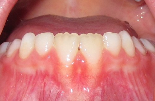 b2ap3_large_Mamelons_Close_up-e1280153313368-500x328 برجستگیهای دندانه ای لبه دندانهای دائمی در کودکان چیست؟