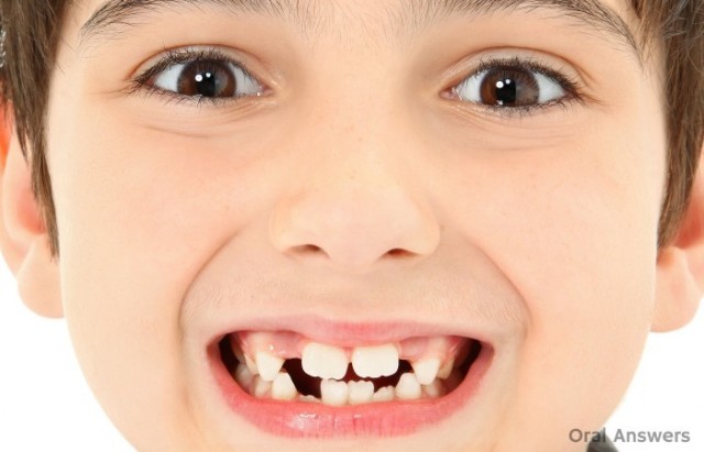 bumps_on_front_teeth_mamelons-700x450