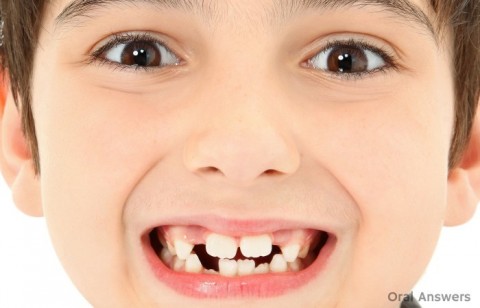 bumps_on_front_teeth_mamelons-700x450