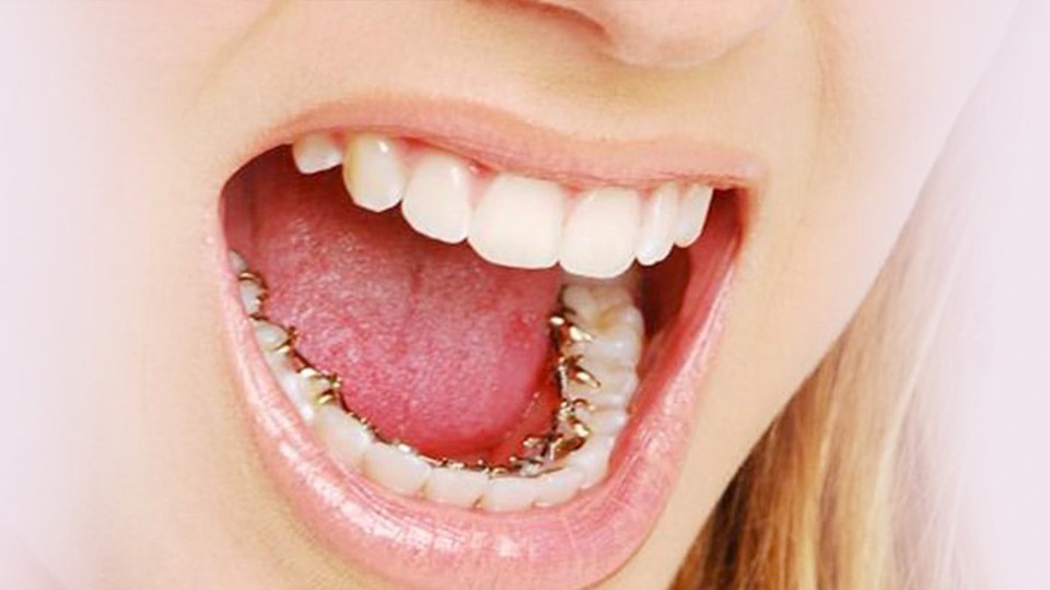 b2ap3_large_8 براکت پشت دندانی یا لینگوال چیست؟