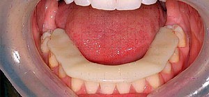 b2ap3_large_spilent3 اسپلینت برای اصلاح نامناسب بودن تماس دندانها با هم (مال اکلوژن)