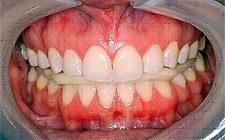 b2ap3_large_spilent4 اسپلینت برای اصلاح نامناسب بودن تماس دندانها با هم (مال اکلوژن)