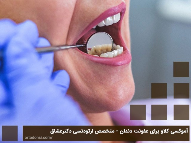 آموکسی کلاو برای عفونت دندان - متخصص ارتودنسی دکتر جمیلیان