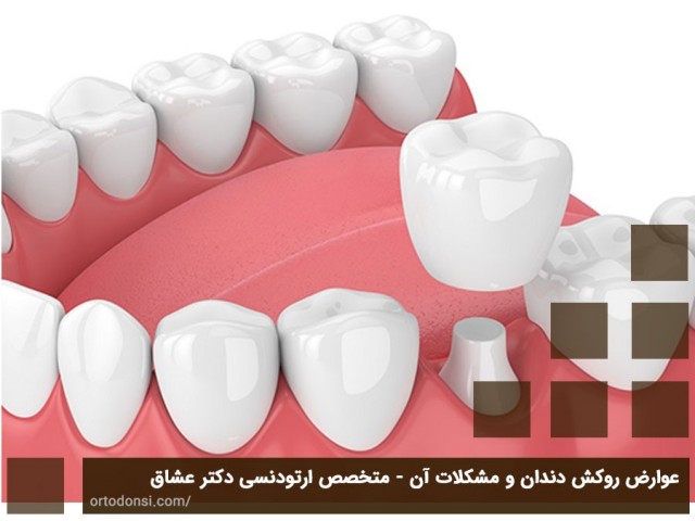 عوارض روکش دندان و مشکلات آن - متخصص ارتودنسی دکتر عشاق