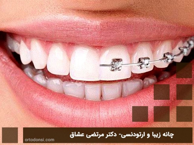 تفاوت لمینت دندان و ارتودنسی