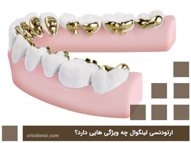 Lingual-orthodontics