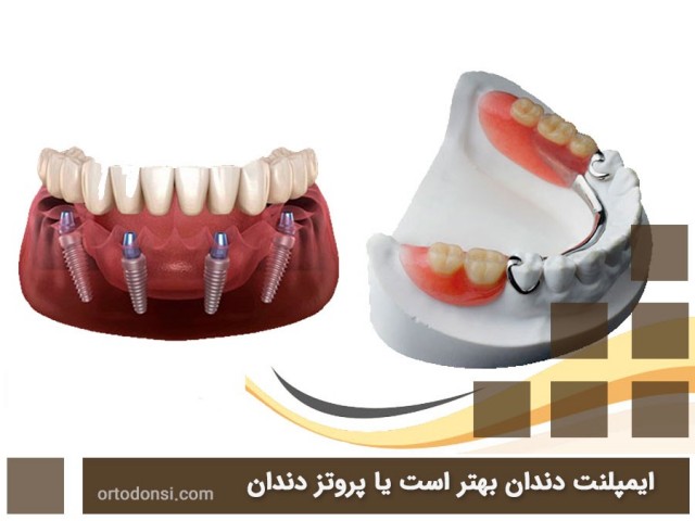 Dental-implants-or-dentures
