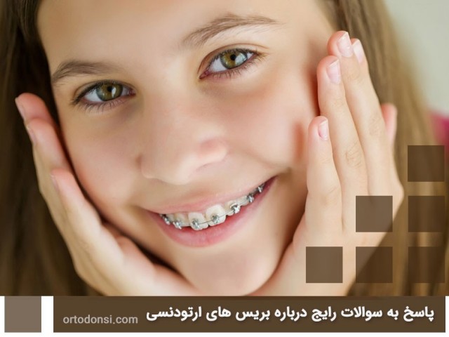 Orthodontic-braces