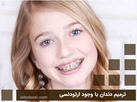 Tooth-restoration-despite-orthodontics