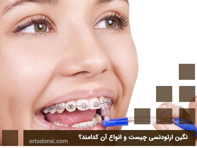 What-is-an-orthodontic-gem