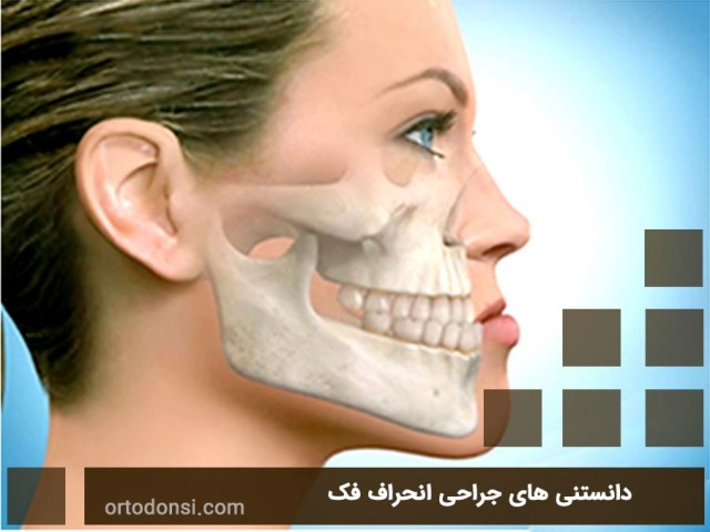 Jaw-protrusion-surgery