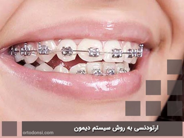 Damon-orthodontics
