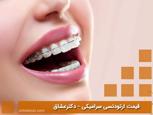 Price-of-ceramic-orthodontics