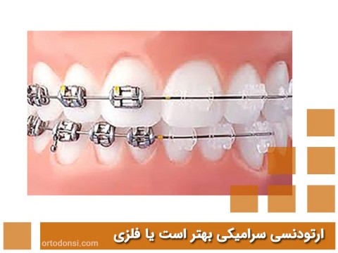 Ceramic-or-metal-orthodontics-is-better