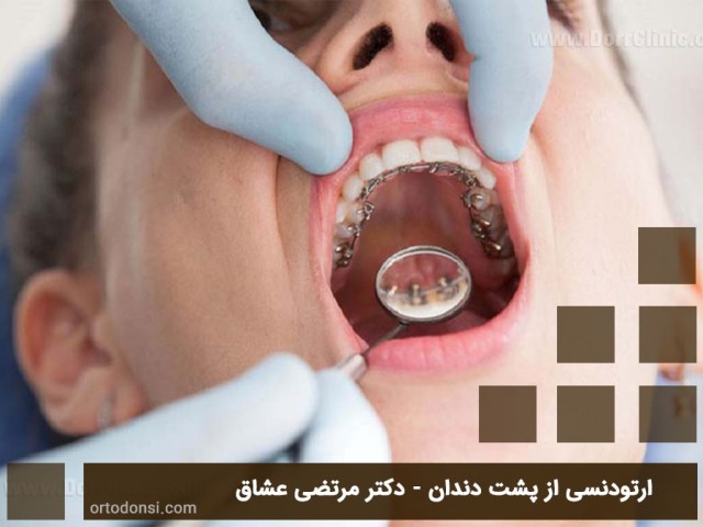 Orthodontics--from-behind-the-teeth