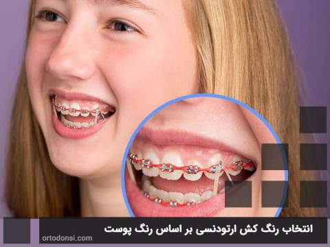 Choosing-orthodontic-colorant-based-on-skin-color