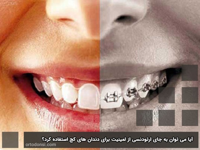 Laminating-and-orthodontics