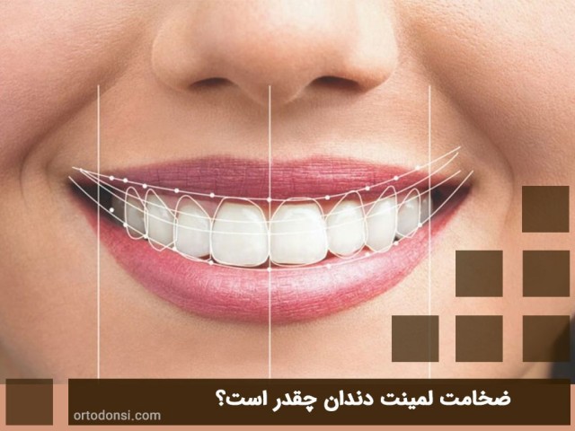 What-is-the-thickness-of-the-dental-laminate