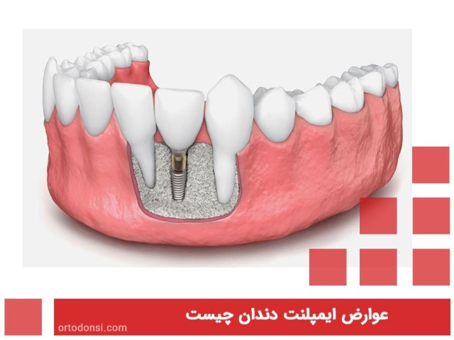 What-are-the-complications-of-dental-implants