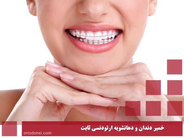 Fixed-orthodontic-toothpaste-and-mouthwash