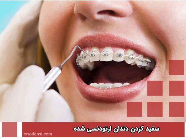 make-wite-tooth-in-orthodonticss