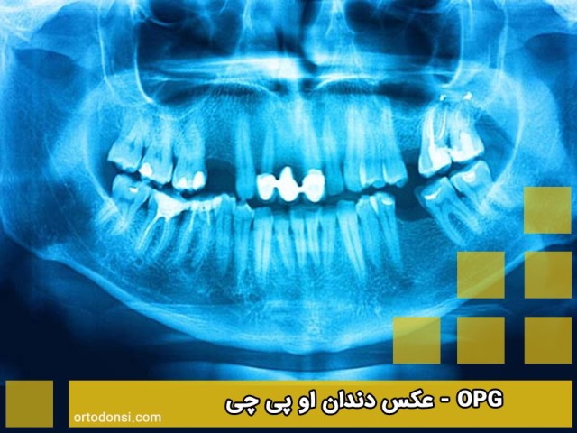 Dental-OPG-photo