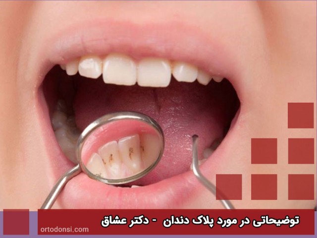Explanations-about-dental-plaque