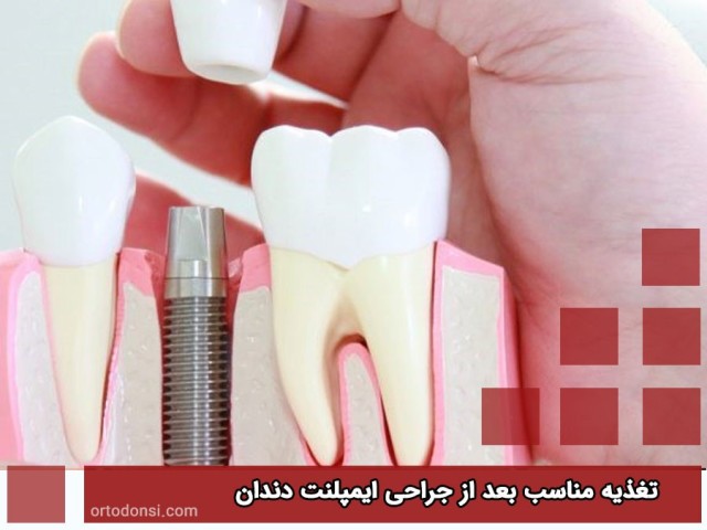 Proper-nutrition-after-dental-implant-surgery