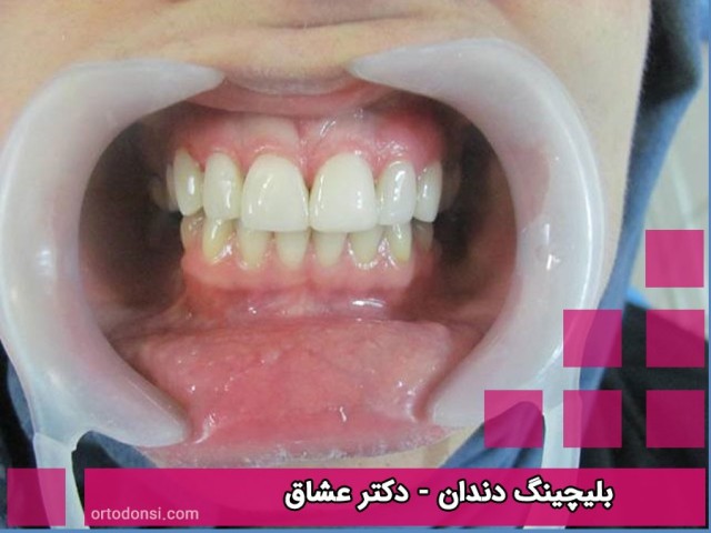 Teeth-bleaching