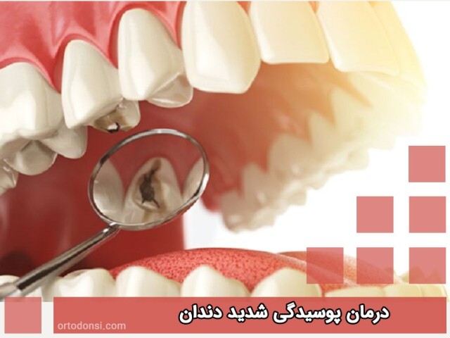 Treatment-of-severe-tooth-decay