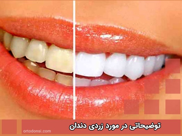 Explanations-about-yellow-teeth