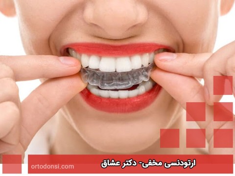 Hidden-orthodontics