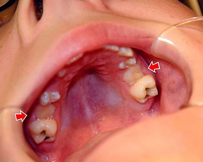 Ankylosed-Upper-Primary-Second-Molars2-1024x820-1 جوش خوردن دندان به استخوان فک (انکیلوز) چه مشکلاتی ایجاد می کند؟