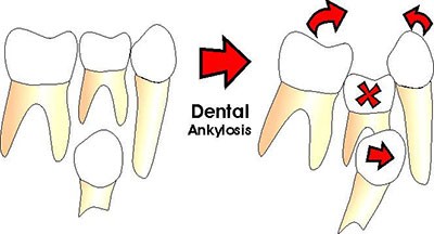 Dental-Ankylosis_1 جوش خوردن دندان به استخوان فک (انکیلوز) چه مشکلاتی ایجاد می کند؟