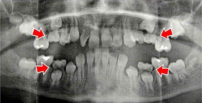 Dental-Xray-Shows-Four-Ankylosed-Primary-Teeth-1024x522 جوش خوردن دندان به استخوان فک (انکیلوز) چه مشکلاتی ایجاد می کند؟