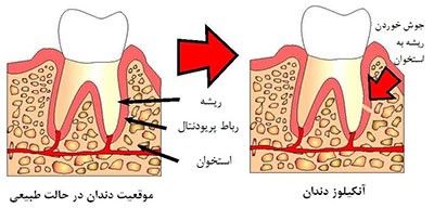 ankilose-dandan جوش خوردن دندان به استخوان فک (انکیلوز) چه مشکلاتی ایجاد می کند؟
