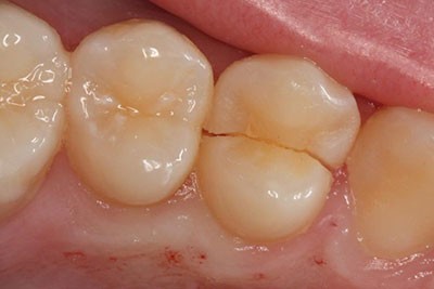b2ap3_thumbnail_Cracked انواع ترک خوردن و شکستگی دندان