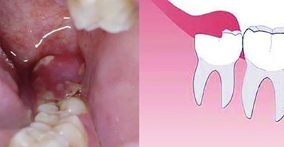 b2ap3_thumbnail_F2 عفونت دندان عقل یا پری کرونیت 