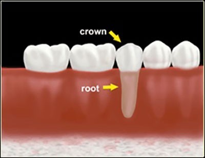 b2ap3_thumbnail_crown_and_root عفونت دندان عقل یا پری کرونیت 