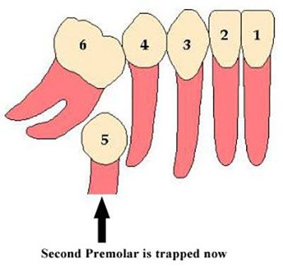 b2ap3_thumbnail_dandane-koodak1 هنگامی که دندان کودک زودتراز موعد می افتد از فضانگهدار کمک بگیرید