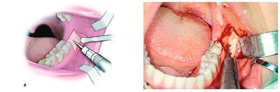b2ap3_thumbnail_jarahi-dandane-aghl دندان نهفته: چرا گاهی دندان زیر لثه باقی می ماند؟