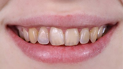b2ap3_thumbnail_minayedandan2 علائم از بین رفتن مینای دندان و درمانهای آن