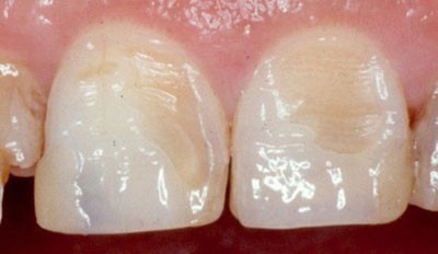 b2ap3_thumbnail_minayedandan3 علائم از بین رفتن مینای دندان و درمانهای آن