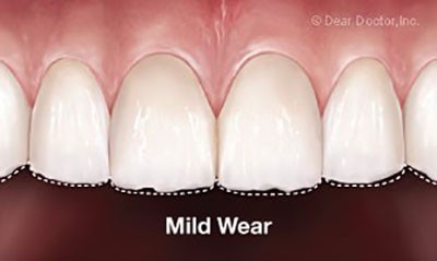 b2ap3_thumbnail_minayedandan4 علائم از بین رفتن مینای دندان و درمانهای آن
