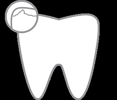 b2ap3_thumbnail_minayedandan6 علائم از بین رفتن مینای دندان و درمانهای آن