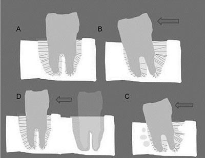 b2ap3_thumbnail_ortodonsi25 در درمان ارتودنسی چگونه دندان حرکت می کند؟