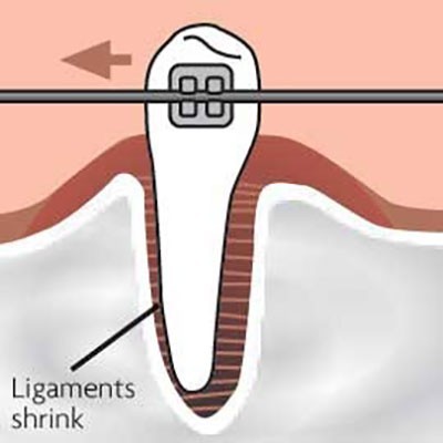 b2ap3_thumbnail_ortodonsi26 در درمان ارتودنسی چگونه دندان حرکت می کند؟