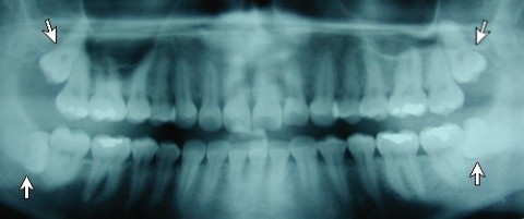 b2ap3_thumbnail_panoramik دندان نهفته: چرا گاهی دندان زیر لثه باقی می ماند؟