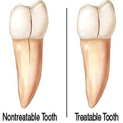 b2ap3_thumbnail_sample19 انواع ترک خوردن و شکستگی دندان